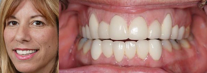 Cosmetic Crowns After