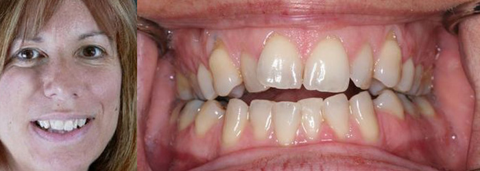 Cosmetic Crowns Before