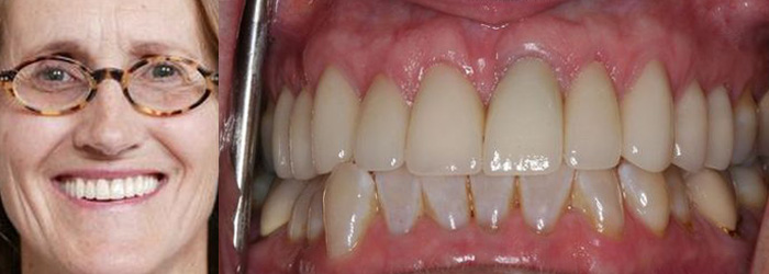 Cosmetic Porcelain After